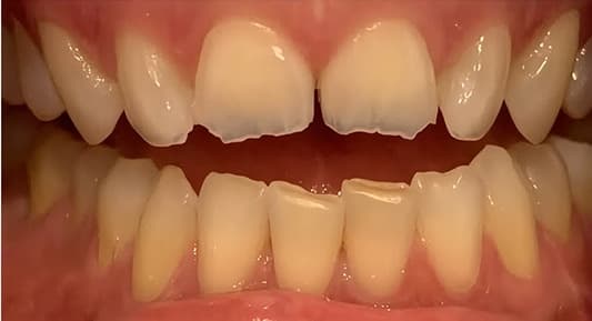 Carillas en dientes anteriores: antes