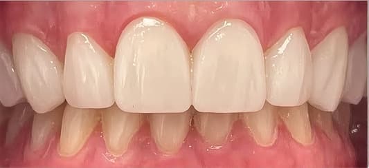 Carillas en dientes anteriores: después