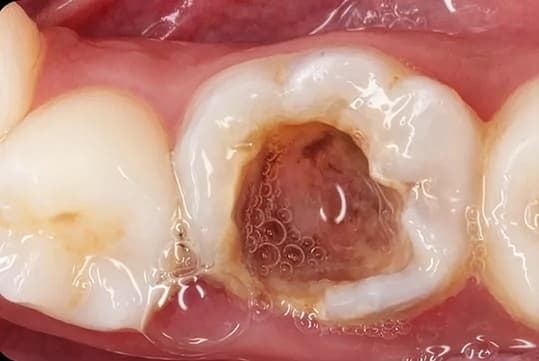 Rehabilitación de molar: antes