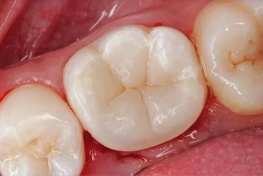 Rehabilitación de molar: después